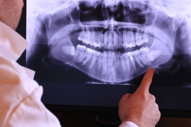Best Emergency Dentist for Lost Fillings or Crowns in Osprey, FL
