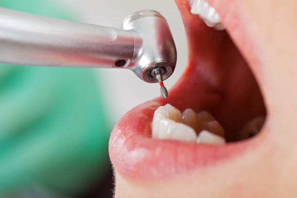Best Emergency Dental Extractions in Osprey, FL